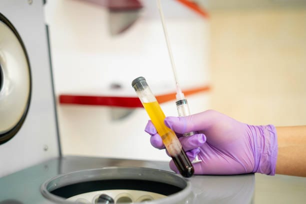 prp-treatment